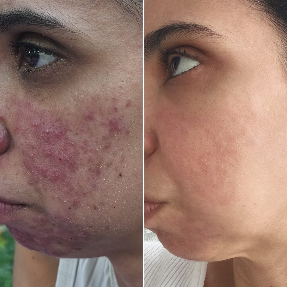 Antes y despu&eacute;s del M&eacute;todo Riv&reg;
