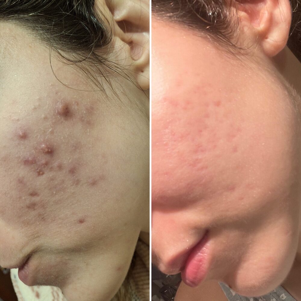 Antes y despu&eacute;s del M&eacute;todo Riv&reg;